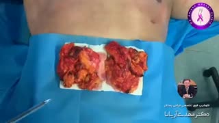 جراحی ژنیکوماستی بسیار شدید توسط دکتر مهدی آریانا
