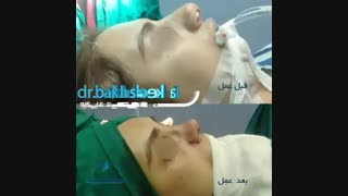 بینی بلافاصله بعد عمل