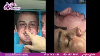 عمل زیبایی بینی