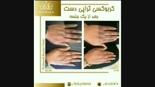 فیلم جوانسازی دست با کربوکسی تراپی