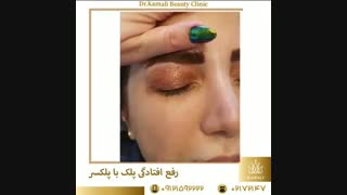 فیلم درمان افتادگی پلک با پلکسر