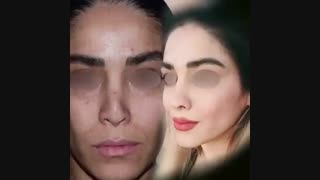 نتیجه جراحی ترمیمی بینی بسیار دشوار بعد از 8 ماه | دکتر باستانی نژاد