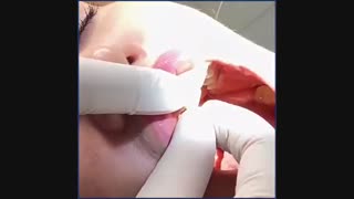 10 واحد روکش فول سرام فک بالا