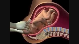 آسیب دیدگی جنین لحظه خروج