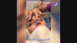 عمل زیبایی بینی توسط دکتر محمد گلی