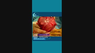 فیلم عمل فیبروم رحمی