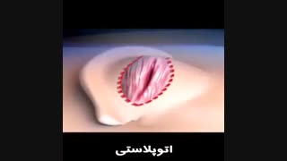 اتوپلاستی