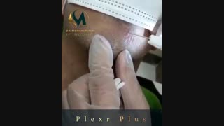 برطرف کردن اسکار(جای زخم) ناشی از تصادف با پلکسر پلاس فراکشنال