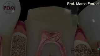 بازسازی تاج دندان و روکش زیرکونیوم