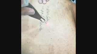 شاهکار پاک کردن تتو در یک جلسه با لیزر بلیچینگ