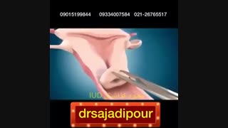 نحوه گذاشتن IUDF