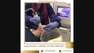 فیلم تاثیر آر اف فرکشنال در جوانسازی صورت