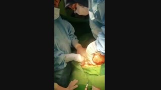 فیلم عمل جراحی توده تخمدان در خانم60ساله توسط دکتر زهرا واحدپورفرد