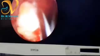 بهترین روش درمان سنگ های حالب