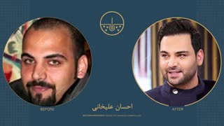 احسان علیخانی قبل و بعد از کاشت مو در کلینیک دکتر نیلفروش زاده