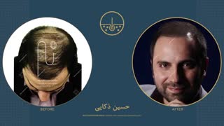 حسین ذکایی قبل و بعد از کاشت مو در کلینیک دکتر نیلفروش زاده