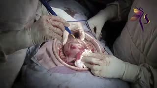 میومکتومی در اوردن فیبروم بزرگ ١٠ سانت