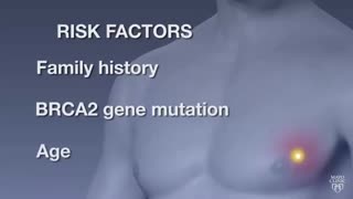 سرطان پستان در مردان