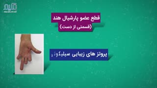 پروتز دست و انواع آن