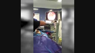 جراحی آندوسکوپی سینوزیت قارچی توسط دکتر شهریار یحیوی