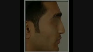 فیلم جراحی بینی شکسته