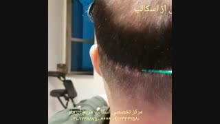 ترمیم اسکار خط بخیه با تکنیک اسکالپ درمان جای جوش
