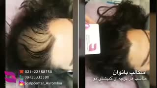 اسکالپ  راه حل قطعی رفع کمپشتی و طاسی
