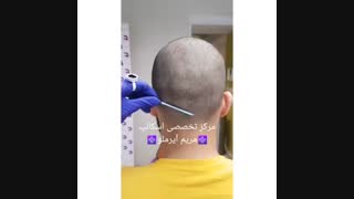 انجام اسکالپ جهت محو محل برداشت کاشت FIT مو انجام شده