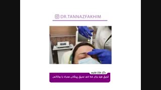 فیلم واقعی تزریق فیلر برای خط اخم عمیق پیشانی همراه با بوتاکس
