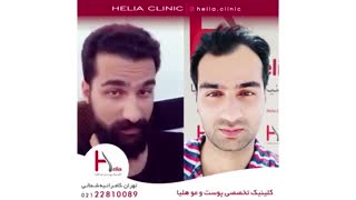 کاشت مو به روش میکروگرافت | کلینیک هلیا | 02122810089 | شماره 63