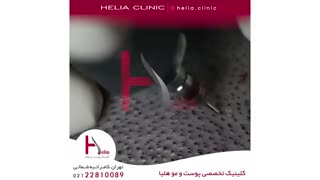 کاشت مو به روش میکروگرافت | کلینیک هلیا | 02122810089 | شماره 64