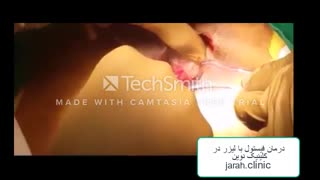 برای درمان فیستول مقعدی زیر تیغ جراحی نروید!!! درمان را به ما بسپارید:  https://jarah.clinic/