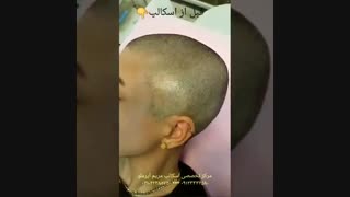 چه کسانی برای انجام اسکالپ در اولویت قرار دارند؟؟؟؟ عمل زیبایی
