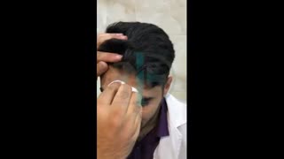 رفع جای زخم با دستگاه ED-DBD PLASMA