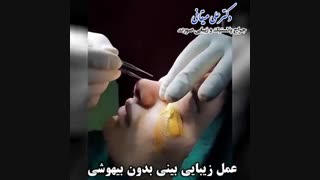 جراحی بینی بدون بیهوشی