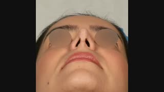 فیلم عمل ترمیم بینی