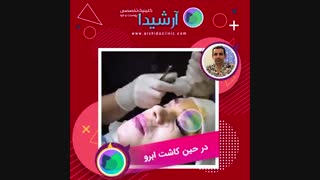 عمل کاشت ابرو