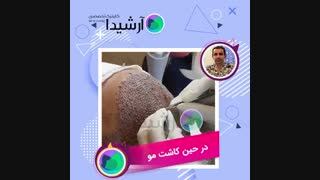 عمل کاشت مو