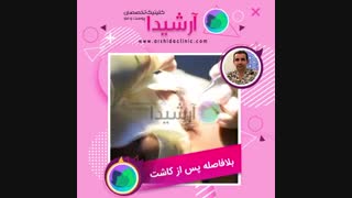 عمل کاشت ابرو