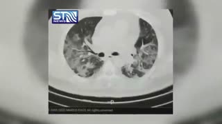 تصویری عبرت آموز از ریه فردی مبتلا به کرونا