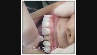 در چه شرایط و مواردی از لمینت دندان یا ونیرهای سرامیکی استفاده میشود؟ | کلینیک دندانپزشکی ایده آل