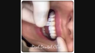 اصلاح طرح لبخند با استفاده از 10 واحد لومینیرز | کلینیک دندانپزشکی ایده آل
