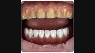 اجرای 10 واحد لمینت سرامیکی جهت اصلاح طرح لبخند | کلینیک دندانپزشکی ایده آل