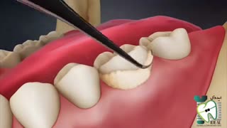 تجمع پلاک های دندانی (جرم) | کلینیک دندانپزشکی ایده آل