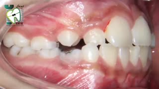 دستگاه پندولوم چیست و چگونه عمل می کند؟ | کلینیک دندانپزشکی ایده آل