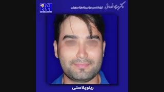 فیلم رینوپلاستی
