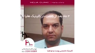 کاشت مو به روش میکروگرافت | کلینیک هلیا | 02122810089 | شماره 70