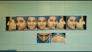 اصلاح کجی شدید بینی استخوانی | دکتر امید ابراهیمی