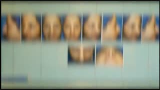 عمل بینی گوشتی توسط جراح بینی تهران دکتر امید ابراهیمی