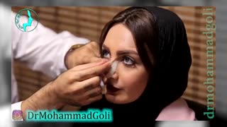 برداشتن چسب بینی پس از عمل | دکتر محمد گلی